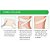 Curativo de Silicone para Cicatriz  Mepiform 10x18 - Molnlycke - Imagem 4