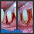 TW Cyan laser azul de Alta Potência Odontologia MMO - Imagem 3