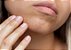 KIT ANTI ACNE - Gel de Limpeza Facial + Sérum Anti Acne + Sérum Clareador - Imagem 3