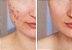 KIT ANTI ACNE - Gel de Limpeza Facial + Sérum Anti Acne + Sérum Clareador - Imagem 2