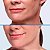 Ácido Hialurônico RESTYLANE® Lyft 1 ml - Imagem 4