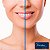 Ácido Hialurônico RESTYLANE® Defyne 1 ml - Imagem 2