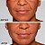 Ácido Hialurônico RESTYLANE® Refyne 1 ml - Imagem 3