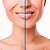 Ácido Hialurônico RESTYLANE® Lidocaine 1 ml - Imagem 4