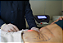 LiftEndo - Endolaser - Medical San - Imagem 9