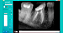 Sensor Intraoral – Saevo Slim – Tamanho 1 - Imagem 4
