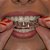 Kit Super de Clareamento Dental Laser - Home Kit Whitening Gel com 44% Peróxido de Carbamida - Imagem 5