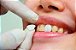 Lentes de Contato Dental Facetas Dentárias Resina 70 unidades  Com Cola - Imagem 4
