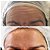 Toxina botulínica- botox - Imagem 3