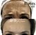 Toxina botulínica- botox - Imagem 5