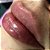 Preenchimento labial - Imagem 2
