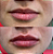 Preenchimento Labial - Imagem 5
