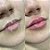 Preenchimento Labial - Imagem 4
