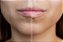 Preenchimento Labial - Imagem 3