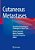 Cutaneous Metastases: Decoding Dermatological Challenges In Cancer Care-.. - Imagem 1