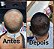 Tônico capilar Minoxidil - Imagem 2