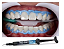 Barreira Gengival Top Dam Blue - Seringa 2G - FGM - Imagem 3
