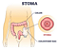 BOLSA COLOSTOMIA 50MM C/ 10UN - Medsonda - Imagem 4