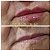 PREENCHIMENTO LABIAL - 1 ml de ácido hialurônico - Promoção - Imagem 3