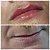 PREENCHIMENTO LABIAL - 1 ml de ácido hialurônico - Promoção - Imagem 2