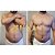 Z REDUX - Lipo enzimática - 5 sessões/30 procedimentos - PROMOÇÃO - Imagem 7