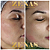 LIMPEZA DE PELE CLAREADORA - 2 sessões - Promoção - Imagem 3