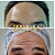 TOXINA BOTULÍNICA - Botox - Imagem 9