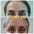 TOXINA BOTULÍNICA - Botox - Imagem 2