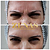 TOXINA BOTULÍNICA - Botox - Imagem 12