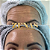 TOXINA BOTULÍNICA - Botox - Imagem 13