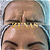 TOXINA BOTULÍNICA - Botox - Imagem 14