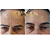 TOXINA BOTULÍNICA - Botox - Imagem 15