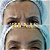 TOXINA BOTULÍNICA - Botox - Imagem 7