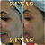 TOXINA BOTULÍNICA - Botox - Imagem 8