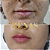 PREENCHIMENTO LABIAL - 1 ml de ácido hialurônico - Imagem 4