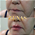PREENCHIMENTO LABIAL - 1 ml de ácido hialurônico - Imagem 5