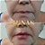 PREENCHIMENTO LABIAL - 1 ml de ácido hialurônico - Imagem 6