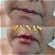 PREENCHIMENTO LABIAL - 1 ml de ácido hialurônico - Imagem 7