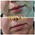 PREENCHIMENTO LABIAL - 1 ml de ácido hialurônico - Imagem 11