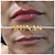 PREENCHIMENTO LABIAL - 1 ml de ácido hialurônico - Imagem 13