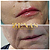 PREENCHIMENTO LABIAL - 1 ml de ácido hialurônico - Imagem 14