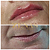 PREENCHIMENTO LABIAL - 1 ml de ácido hialurônico - Imagem 2