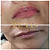 PREENCHIMENTO LABIAL - 1 ml de ácido hialurônico - Imagem 16