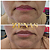PREENCHIMENTO DE MARIONETE - 1 ml de ácido hialurônico - Imagem 6