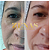 MICROAGULHAMENTO FACIAL - Imagem 2