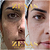 MICROAGULHAMENTO FACIAL - Imagem 3