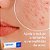 Acnezil tratamento da acne e espinha 20g peroxido de benzoila cimed - Imagem 3