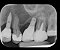 Raio-X Intraoral Pantográfico DC X-Mind Parede Alta Frequência - Acteon - Imagem 6