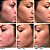 Dr. Dennis Gross Skincare DRx Blemish Solutions™ Acne Eliminating Gel - Imagem 2