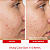 First Aid Beauty Acne Clearing Pads - 2% Salicylic Acid Acne Treatment - Imagem 3